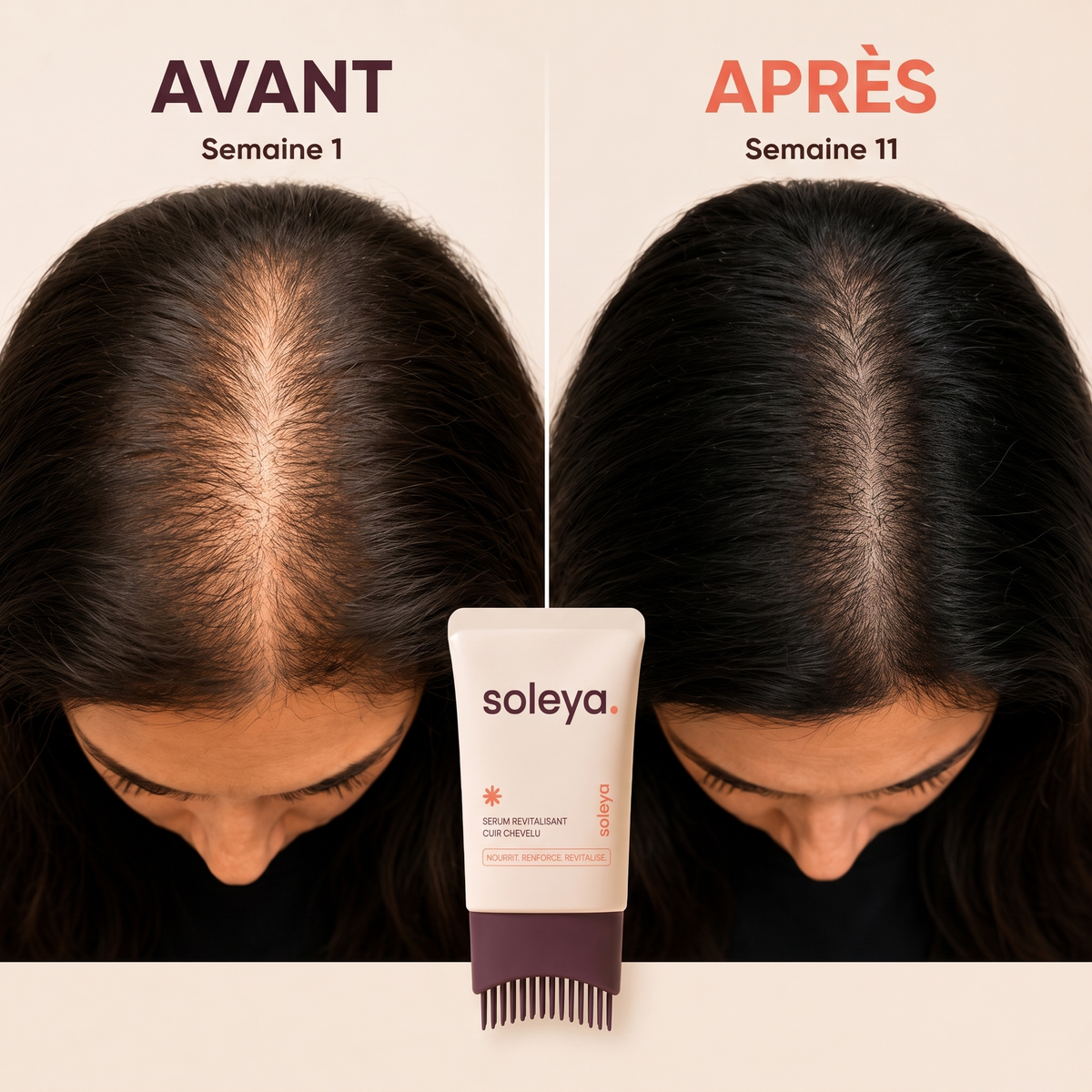 Avant apres cuir chevelu Soleya